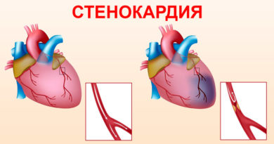 Стенокардия, одно из проявлений ишемической болезни сердца - заболевание