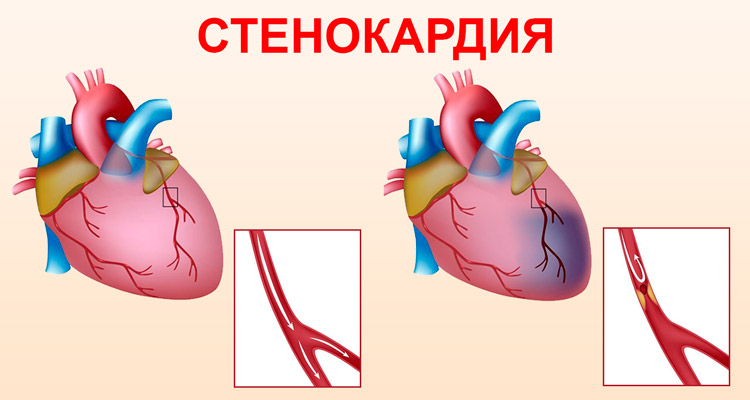 Стенокардия, одно из проявлений ишемической болезни сердца - заболевание